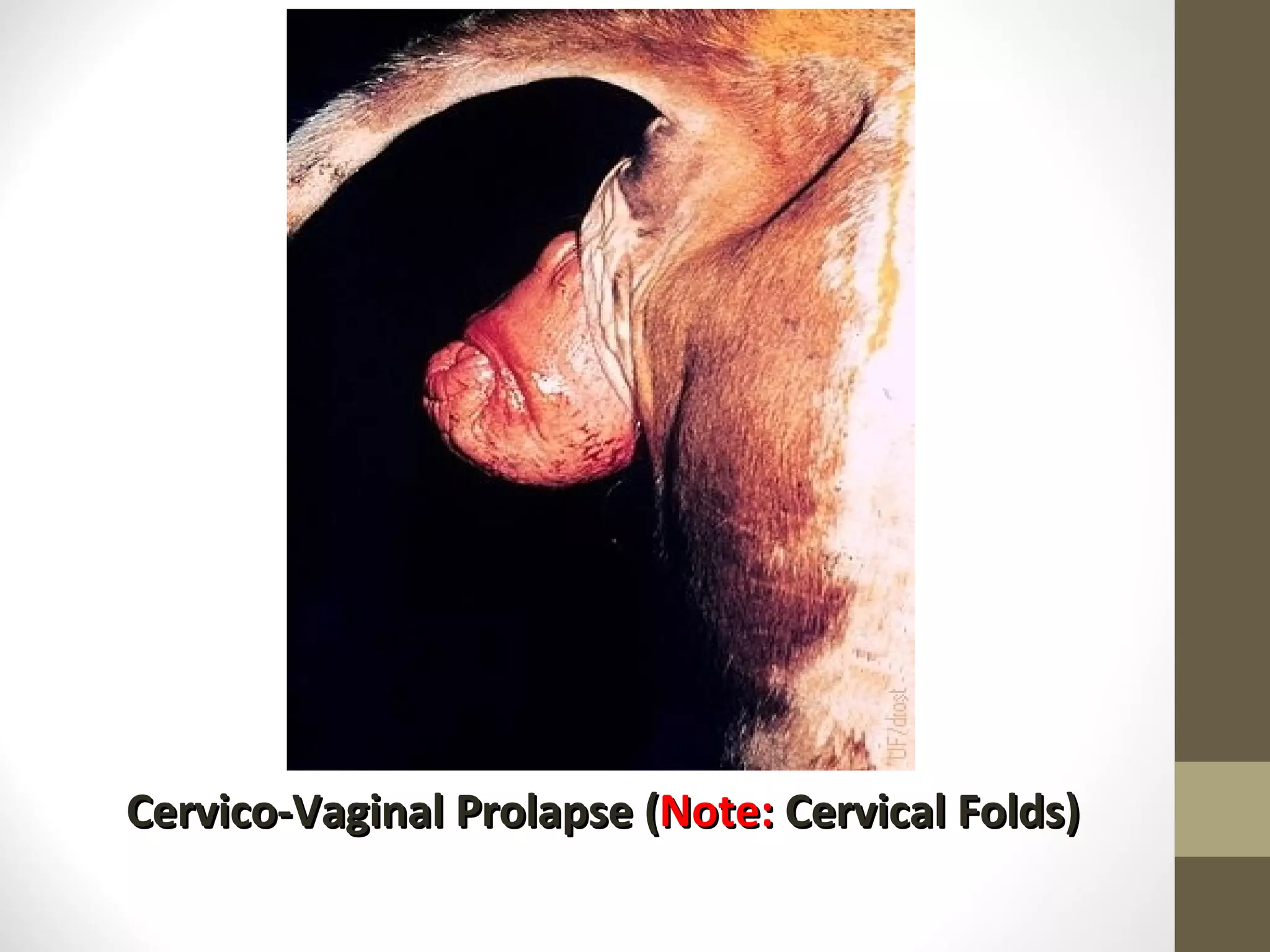 Cervico-Vaginal Prolapse ( Note: Cervical Folds)
