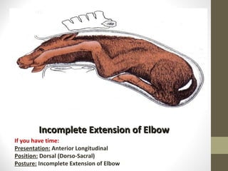 Incomplete Extension of Elbow If you have time: Presentation:  Anterior Longitudinal Position:  Dorsal (Dorso-Sacral) Posture:  Incomplete Extension of Elbow 