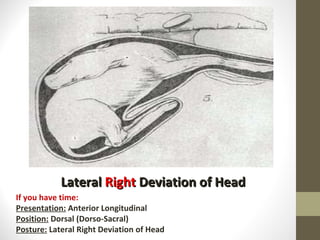 Lateral  Right  Deviation of Head If you have time: Presentation:  Anterior Longitudinal Position:  Dorsal (Dorso-Sacral) Posture:  Lateral Right Deviation of Head 