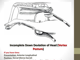Incomplete Down Deviation of Head ( Vertex Posture ) If you have time: Presentation:  Anterior Longitudinal Position:  Dorsal (Dorso-Sacral) Posture:   Incomplete Down Deviation of Head ( Vertex Posture ) 