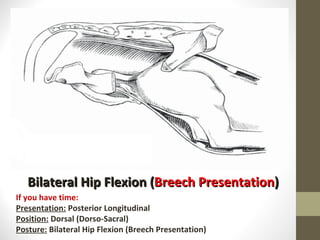 Bilateral Hip Flexion ( Breech Presentation ) If you have time: Presentation:  Posterior Longitudinal Position:  Dorsal (Dorso-Sacral) Posture:  Bilateral Hip Flexion (Breech Presentation) 