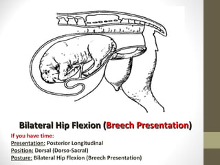 Bilateral Hip Flexion ( Breech Presentation ) If you have time: Presentation:  Posterior Longitudinal Position:  Dorsal (Dorso-Sacral) Posture:  Bilateral Hip Flexion (Breech Presentation) 