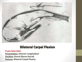 Bilateral Carpal Flexion If you have time: Presentation:  Anterior Longitudinal Position:  Dorsal (Dorso-Sacral) Posture:  Bilateral Carpal Flexion 