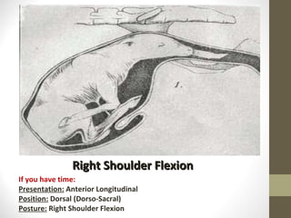 Right Shoulder Flexion If you have time: Presentation:  Anterior Longitudinal Position:  Dorsal (Dorso-Sacral) Posture:  Right Shoulder Flexion 