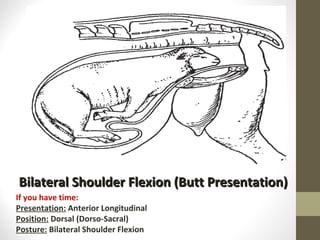 Bilateral Shoulder Flexion (Butt Presentation) If you have time: Presentation:  Anterior Longitudinal Position:  Dorsal (Dorso-Sacral) Posture:  Bilateral Shoulder Flexion 