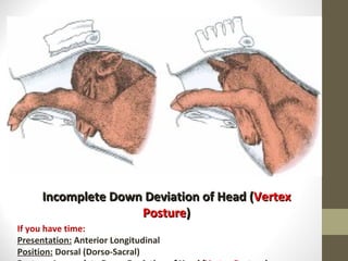 Incomplete Down Deviation of Head ( Vertex Posture ) If you have time: Presentation:  Anterior Longitudinal Position:  Dorsal (Dorso-Sacral) Posture:   Incomplete Down Deviation of Head ( Vertex Posture ) 