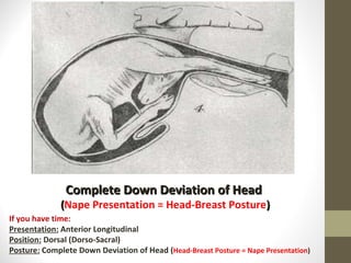 Complete Down Deviation of Head  ( Nape Presentation = Head-Breast Posture ) If you have time: Presentation:  Anterior Longitudinal Position:  Dorsal (Dorso-Sacral) Posture:  Complete Down Deviation of Head ( Head-Breast Posture = Nape Presentation ) 