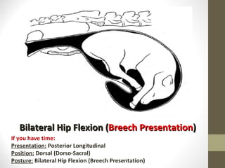 Bilateral Hip Flexion ( Breech Presentation ) If you have time: Presentation:  Posterior Longitudinal Position:  Dorsal (Dorso-Sacral) Posture:  Bilateral Hip Flexion (Breech Presentation) 