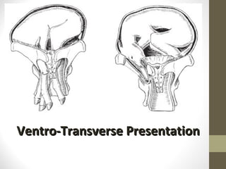 Ventro-Transverse Presentation 
