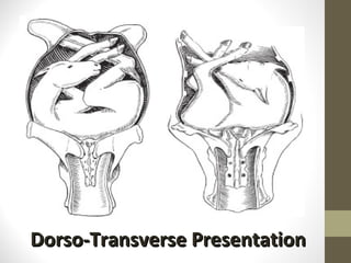Dorso-Transverse Presentation 