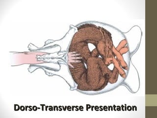 Dorso-Transverse Presentation 