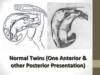 Normal Twins (One Anterior & other Posterior Presentation) 