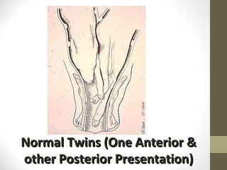 Normal Twins (One Anterior & other Posterior Presentation) 