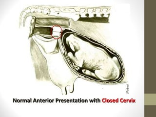 Normal Anterior Presentation with  Closed Cervix 