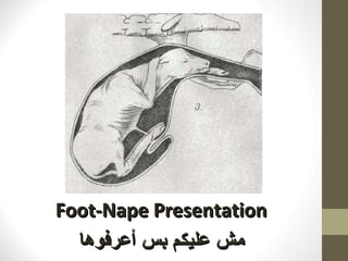 Foot-Nape Presentation مش عليكم بس أعرفوها 