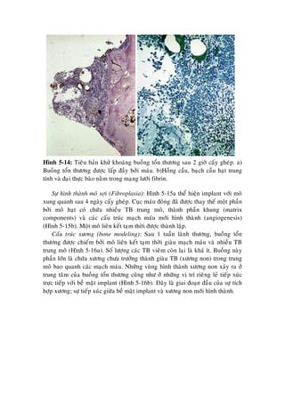 Hình 5-14: Tieâu baûn khöû khoaùng buoàng toån thöông sau 2 giôø caáy gheùp. a)
Buoàng toån thöông ñöôïc laáp ñaày bôûi maùu. b)Hoàng caàu, baïch caàu haït trung
tính vaø ñaïi thöïc baøo naèm trong maïng löôùi fibrin.
Söï hình thaønh moâ sôïi (Fibroplasia): Hình 5-15a theå hieän implant vôùi moâ
xung quanh sau 4 ngaøy caáy gheùp. Cuïc maùu ñoâng ñaõ ñöôïc thay theá moät phaàn
bôûi moâ haït coù chöùa nhieàu TB trung moâ, thaønh phaàn khung (matrix
components) vaø caùc caáu truùc maïch maùu môùi hình thaønh (angiogenesis)
(Hình 5-15b). Moät moâ lieân keát taïm thôøi ñöôïc thaønh laäp.
Caáu truùc xöông (bone modeling): Sau 1 tuaàn laønh thöông, buoàng toån
thöông ñöôïc chieám bôûi moâ lieân keát taïm thôøi giaøu maïch maùu vaø nhieàu TB
trung moâ (Hình 5-16a). Soá löôïng caùc TB vieâm coøn laïi laø khaù ít. Buoàng naøy
phaàn lôùn laø chöùa xöông chöa tröôûng thaønh giaøu TB (xöông non) trong trung
moâ bao quanh caùc maïch maùu. Nhöõng vuøngï hình thaønh xöông non xaûy ra ôû
trung taâm cuûa buoàng toån thöông cuõng nhö ôû nhöõng vò trí rieâng leû tieáp xuùc
tröïc tieáp vôùi beà maët implant (Hình 5-16b). Ñaây laø giai ñoaïn ñaàu cuûa söï tích
hôïp xöông; söï tieáp xuùc giöõa beà maët implant vaø xöông non môùi hình thaønh.
 