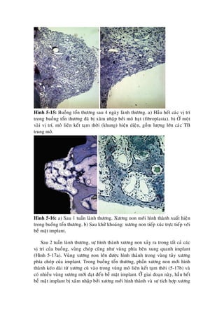 Hình 5-15: Buoàng toån thöông sau 4 ngaøy laønh thöông. a) Haàu heát caùc vò trí
trong buoàng toån thöông ñaõ bò xaâm nhaäp bôûi moâ haït (fibroplasia). b) ÔÛ moät
vaøi vò trí, moâ lieân keát taïm thôøi (khung) hieän dieän, goàm löôïng lôùn caùc TB
trung moâ.
Hình 5-16: a) Sau 1 tuaàn laønh thöông. Xöông non môùi hình thaønh xuaát hieän
trong buoàng toån thöông. b) Sau khöû khoaùng: xöông non tieáp xuùc tröïc tieáp vôùi
beà maët implant.
Sau 2 tuaàn laønh thöông, söï hình thaønh xöông non xaûy ra trong taát caû caùc
vò trí cuûa buoàng, vuøng choùp cuõng nhö vuøng phía beân xung quanh implant
(Hình 5-17a). Vuøng xöông non lôùn ñöôïc hình thaønh trong vuøng tuûy xöông
phía choùp cuûa implant. Trong buoàng toån thöông, phaàn xöông non môùi hình
thaønh keùo daøi töø xöông cuõ vaøo trong vuøng moâ lieân keát taïm thôøi (5-17b) vaø
coù nhieàu vuøng xöông môùi ñaït ñeán beà maët implant. ÔÛ giai ñoaïn naøy, haàu heát
beà maët implant bò xaâm nhaäp bôûi xöông môùi hình thaønh vaø söï tích hôïp xöông
 