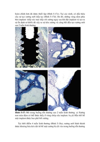hoaøn chænh hôn ñaõ ñöôïc thieát laäp (Hình 5-17c). Taïi caùc raõnh, coù daáu hieäu
cuûa söï taïo xöông môùi tieáp tuïc (Hình 5-17d). Do ñoù, nhöõng vuøng naèm phía
beân implant (tieáp xuùc tröïc tieáp vôùi xöông ngay sau khi ñaët implant vaø taïo ra
söï oån ñònh sô khôûi) ñaõ xaûy ra söï tieâu xöông vaø cuõng baét ñaàu taïo xöông môùi
sau 2 tuaàn laønh thöông.
Hình 5-17: Moâ trong buoàng toån thöông sau 2 tuaàn laønh thöông. a) Xöông
non maøu ñaäm coù theå ñöôïc thaáy ôû vuøng choùp cuûa implant. b,c,d) Haàu heát beà
maët implant ñöôïc bao phuû bôûi xöông.
Taïi thôøi ñieåm 4 tuaàn laønh thöông (Hình 5-18a), xöông môùi hình thaønh
ñöôïc khoaùng hoùa keùo daøi töø beà maët xöông bò caét vaøo trong buoàng toån thöông
 