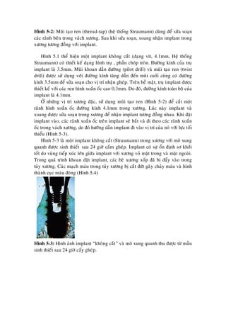 Hình 5-2: Muõi taïo ren (thread-tap) (heä thoáng Straumann) duøng ñeå söûa soaïn
caùc raõnh beân trong vaùch xöông. Sau khi söûa soaïn, xoang nhaän implant trong
xöông töông ñoàng vôùi implant.
Hình 5.1 theå hieän moät implant khoâng caét (daïng vít, 4.1mm, Heä thoáng
Straumann) coù thieát keá daïng hình truï , phaàn choùp troøn. Ñöôøng kính cuûa truï
implant laø 3.5mm. Muõi khoan daãn ñöôøng (pilot drill) vaø muõi taïo ren (twist
drill) ñöôïc söû duïng vôùi ñöôøng kính taêng daàn ñeán muõi cuoái cuøng coù ñöôøng
kính 3.5mm ñeå söûa soaïn cho vò trí nhaän gheùp. Treân beà maët, truï implant ñöôïc
thieát keá vôùi caùc ren hình xoaén oác cao 0.3mm. Do ñoù, ñöôøng kính toaøn boä cuûa
implant laø 4.1mm.
ÔÛ nhöõng vò trí xöông ñaëc, söû duïng muõi taïo ren (Hình 5-2) ñeå caét moät
raõnh hình xoaén oác ñöôøng kính 4.1mm trong xöông. Luùc naøy implant vaø
xoang ñöôïc söûa soaïn trong xöông ñeå nhaän implant töông ñoàng nhau. Khi ñaët
implant vaøo, caùc raõnh xoaén oác treân implant seõ baét vaø ñi theo caùc raõnh xoaén
oác trong vaùch xöông, do ñoù höôùng daãn implant ñi vaøo vò trí cuûa noù vôùi löïc toái
thieåu (Hình 5-3).
Hình 5-3 laø moät implant khoâng caét (Straumann) trong xöông vôùi moâ xung
quanh ñöôïc sinh thieát sau 24 giôø caém gheùp. Implant coù söï oån ñònh sô khôûi
toát do vuøng tieáp xuùc lôùn giöõa implant vôùi xöông voû maët trong vaø maët ngoaøi.
Trong quaù trình khoan ñaët implant, caùc beø xöông xoáp ñaõ bò ñaåy vaøo trong
tuûy xöông. Caùc maïch maùu trong tuûy xöông bò caét ñöùt gaây chaûy maùu vaø hình
thaønh cuïc maùu ñoâng (Hình 5.4)
Hình 5-3: Hình aûnh implant “khoâng caét” vaø moâ xung quanh thu ñöôïc töø maãu
sinh thieát sau 24 giôø caáy gheùp.
 