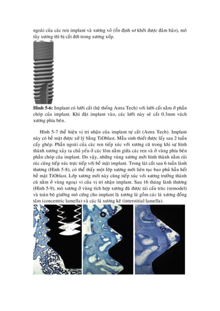 ngoaøi cuûa caùc ren implant vaø xöông voû (oån ñònh sô khôûi ñöôïc ñaûm baûo), moâ
tuûy xöông thì bò caét ñöùt trong xöông xoáp.
Hình 5-6: Implant coù löôõi caét (heä thoáng Astra Tech) vôùi löôõi caét naèm ôû phaàn
choùp cuûa implant. Khi ñaët implant vaøo, caùc löôõi naøy seõ caét 0.3mm vaùch
xöông phía beân.
Hình 5-7 theå hieän vò trí nhaän cuûa implant töï caét (Astra Tech). Implant
naøy coù beà maët ñöôïc xöû lyù baèng TiOblast. Maãu sinh thieát ñöôïc laáy sau 2 tuaàn
caáy gheùp. Phaàn ngoaøi cuûa caùc ren tieáp xuùc vôùi xöông cuõ trong khi söï hình
thaønh xöông xaûy ra chuû yeáu ôû caùc loõm naèm giöõa caùc ren vaø ôû vuøng phía beân
phaàn choùp cuûa implant. Do vaäy, nhöõng vuøng xöông môùi hình thaønh naèm raûi
raùc cuõng tieáp xuùc tröïc tieáp vôùi beà maët implant. Trong laùt caét sau 6 tuaàn laønh
thöông (Hình 5-8), coù theå thaáy moät lôùp xöông môùi lieân tuïc bao phuû haàu heát
beà maët TiOblast. Lôùp xöông môùi naøy cuõng tieáp xuùc vôùi xöông tröôûng thaønh
cuõ naèm ôû vuøng ngoaïi vi cuûa vò trí nhaän implant. Sau 16 thaùng laønh thöông
(Hình 5-9), moâ xöông ôû vuøng tích hôïp xöông ñaõ ñöôïc taùi caáu truùc (remodel)
vaø toaøn boä giöôøng moâ cöùng cho implant laø xöông laù goàm caùc laù xöông ñoàng
taâm (concentric lamella) vaø caùc laù xöông keõ (interstitial lamella).
 