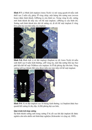 Hình 5-7: a) Hình aûnh implant (Astra Tech) vaø moâ xung quanh töø maãu sinh
thieát sau 2 tuaàn caáy gheùp. ÔÛ vuøng choùp, moät löôïng lôùn xöông non (woven
bone) ñöôïc hình thaønh. b)Phoùng to cuûa hình (a). Trong vuøng bò caét, xöông
môùi hình thaønh ñaõ tieáp xuùc vôùi beà maët implant. c)Phoùng to cuûa hình (b).
Xöông môùi hình thaønh keùo daøi töø xöông cuõ, ñi tôùi beà maët implant ôû vuõng
loõm giöõa hai ren lieân tieáp cuûa implant.
Hình 5-8: Hình aûnh vò trí ñaët implant (Implant töï caét Astra Tech) töø maãu
sinh thieát sau 6 tuaàn laønh thöông. a)ÔÛ vuøng rìa, moät lôùp xöông lieân tuïc bao
phuû haàu heát beà maët TiOblast cuûa implant. b) ÔÛ ñoä phoùng ñaïi lôùn hôn. Vuøng
xöông môùi taïo thaønh (baét maøu ñaäm) tieáp xuùc tröïc tieáp vôùi beà maët implant.
Hình 5-9: Vò trí ñaët implant sau 16 thaùng laønh thöông. (a) Implant ñöôïc bao
quanh bôûi xöông laù daøy ñaëc. b) Ñoä phoùng ñaïi cao hôn.
Quaù trình tích hôïp xöông
Söï hình thaønh xöông môùi trong xöông oå bò caét sau khi ñaët implant ñaõ ñöôïc
nghieân cöùu treân nhieàu moâ hình thöïc nghieäm (Schroeder vaø coäng söï, 1995).
 