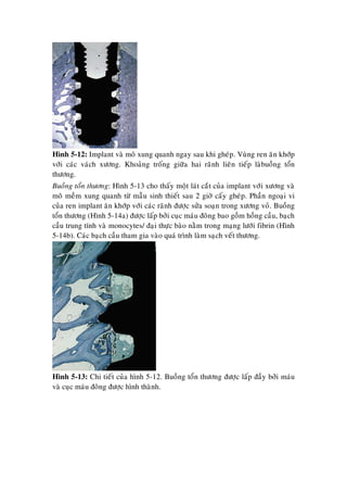 Hình 5-12: Implant vaø moâ xung quanh ngay sau khi gheùp. Vuøng ren aên khôùp
vôùi caùc vaùch xöông. Khoaûng troáng giöõa hai raõnh lieân tieáp laøbuoàng toån
thöông.
Buoàng toån thöông: Hình 5-13 cho thaáy moät laùt caét cuûa implant vôùi xöông vaø
moâ meàm xung quanh töø maãu sinh thieát sau 2 giôø caáy gheùp. Phaàn ngoaïi vi
cuûa ren implant aên khôùp vôùi caùc raõnh ñöôïc söûa soaïn trong xöông voû. Buoàng
toån thöông (Hình 5-14a) ñöôïc laáp bôûi cuïc maùu ñoâng bao goàm hoàng caàu, baïch
caàu trung tính vaø monocytes/ ñaïi thöïc baøo naèm trong maïng löôùi fibrin (Hình
5-14b). Caùc baïch caàu tham gia vaøo quaù trình laøm saïch veát thöông.
Hình 5-13: Chi tieát cuûa hình 5-12. Buoàng toån thöông ñöôïc laáp ñaày bôûi maùu
vaø cuïc maùu ñoâng ñöôïc hình thaønh.
 