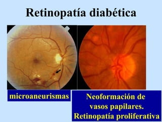 Retinopatía diabética
microaneurismas Neoformación de
vasos papilares.
Retinopatía proliferativa
 