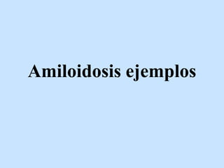 Amiloidosis ejemplos
 