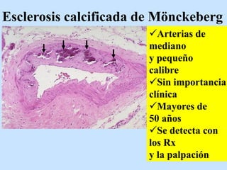 Esclerosis calcificada de Mönckeberg
Arterias de
mediano
y pequeño
calibre
Sin importancia
clínica
Mayores de
50 años
Se detecta con
los Rx
y la palpación
 