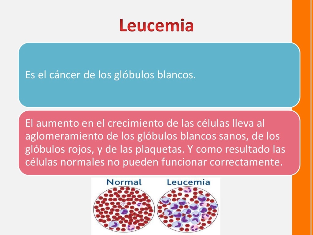 Diferencias Entre Linfoma Y Leucemia Leucemia y linfoma en Pediatría