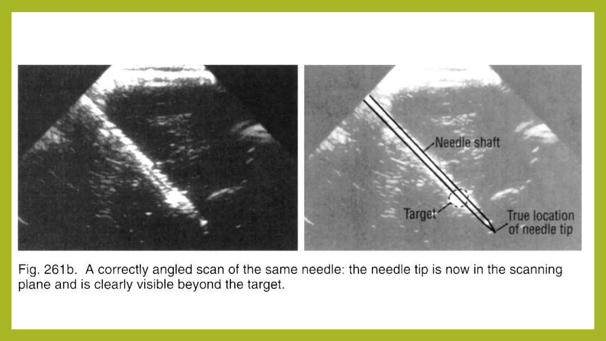 5 ultrasound guided needle biopsy | PPTX