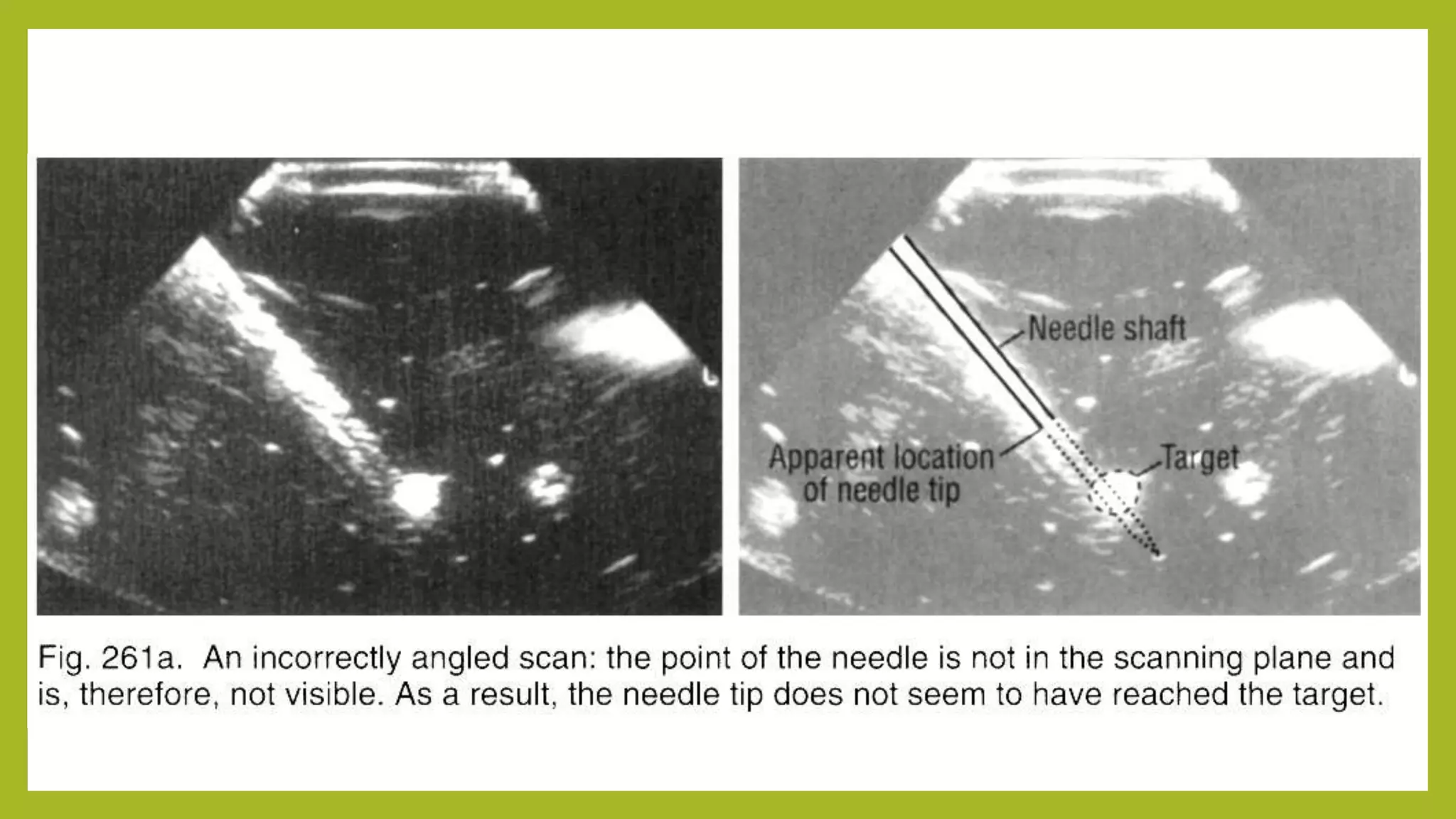 5 ultrasound guided needle biopsy | PPTX