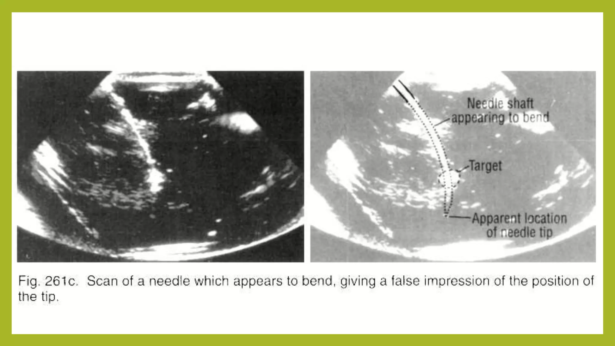 5 ultrasound guided needle biopsy | PPTX