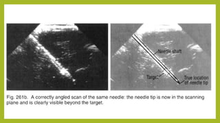 5 ultrasound guided needle biopsy | PPTX