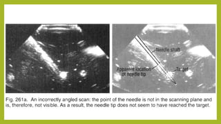 5 ultrasound guided needle biopsy | PPTX