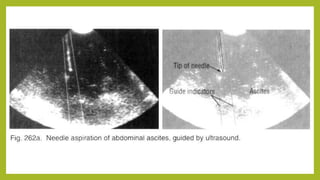 5 ultrasound guided needle biopsy | PPTX