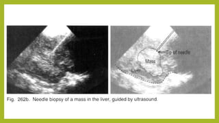 5 ultrasound guided needle biopsy | PPTX