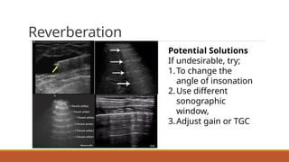 Emporal Reverberation 5 Ultrasound Artifacts in imaging2.pptx