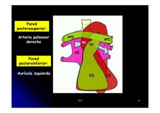 TP
Ao
AI
APD
API
Pared
posterosuperior:
Arteria pulmonar
derecha
Pared
VD VI
Pared
posteroinferior:
Aurícula izquierda
CFC 27
 