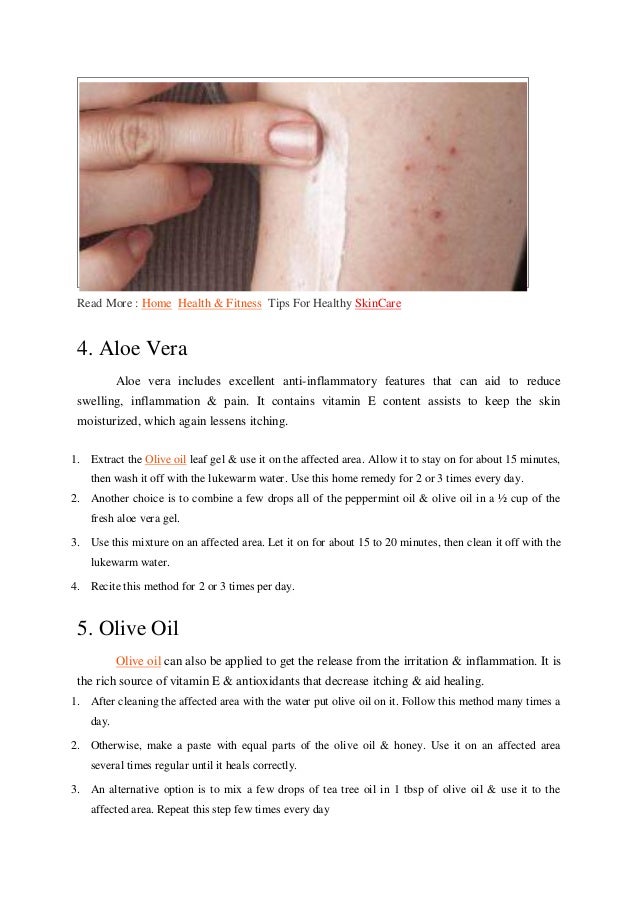 5 ways to treat chigger bites