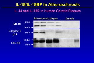 Caspase-1
p10
10 Kd
hIL18R
105 Kd
75 Kd
IL-18/IL-18BP in Atherosclerosis
IL-18 and IL-18R in Human Carotid Plaques
hIL18
25 Kd
15 Kd
Atherosclerotic plaques Controls
 