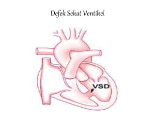 Defek Sekat Ventikel
 