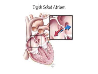 Defek Sekat Atrium
 