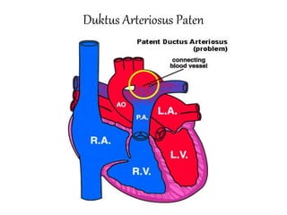 Duktus Arteriosus Paten
 