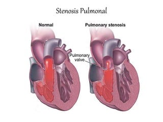 Stenosis Pulmonal
 