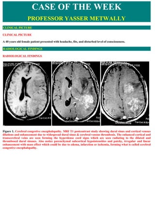 CASE OF THE WEEK
                   PROFESSOR YASSER METWALLY
CLINICAL PICTURE

CLINICAL PICTURE

A 40 years old female patient presented with headache, fits, and disturbed level of consciousness.

RADIOLOGICAL FINDINGS

RADIOLOGICAL FINDINGS  




Figure 1. Cerebral congestive encephalopathy. MRI T1 postcontrast study showing dural sinus and cortical venous
dilations and enhancement due to widespread dural sinus & cerebral venous thrombosis. The enhanced cortical and
transcerebral veins are seen forming the hyperdense cord signs which are seen radiating to the dilated and
thrombosed dural sinuses. Also notice parenchymal subcortical hypointensities and patchy, irregular and linear
enhancement with mass effect which could be due to edema, infarction or ischemia, forming what is called cerebral
congestive encephalopathy.
 