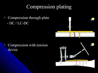 Lab Plate Compression Plates-form and function | PPT