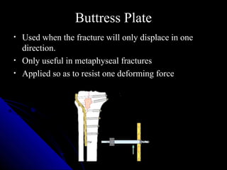 Buttress Plate
•   Used when the fracture will only displace in one
    direction.
•   Only useful in metaphyseal fractures
•   Applied so as to resist one deforming force
 