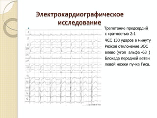 




Электрокардиографическое
исследование
Трепетание предсердий
с кратностью 2:1
ЧСС 130 ударов в минуту
Резкое отклонение ЭОС
влево (угол альфа -63 )
Блокада передней ветви
левой ножки пучка Гиса.

 