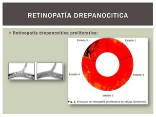  Retinopatía drepanocitica proliferativa:
RETINOPATÍA DREPANOCITICA
 